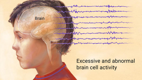 ATASI EPILEPSI